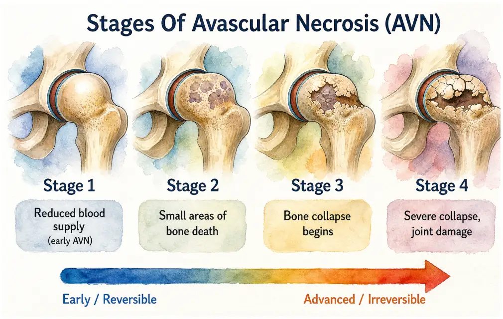 The stages of avascular necrosis of the hip