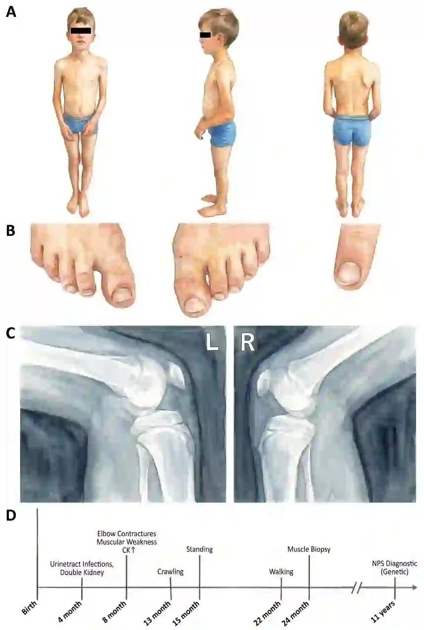 Nail Patella Syndrome