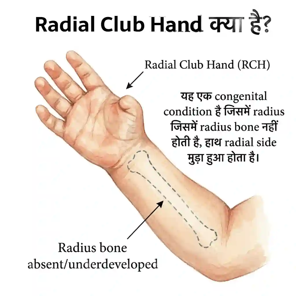 Radial Club Hand: What is it?