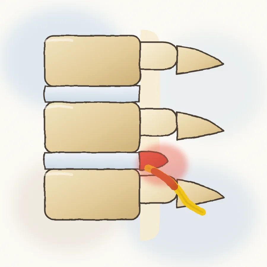 Herniated lumbar disc pressing on a nerve root